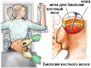 Проведение биопсии костного мозга