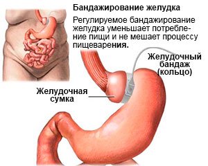 Как происходит операция бандажирования желудка