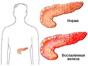 Поджелудочная железа в нормальном и воспалённом состоянии
