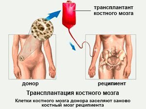 Процедура трансплантации костного мозга