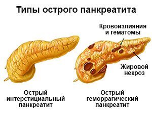Типы острого панкреатита