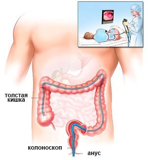 Как проводится колоноскопия кишечника в израильских клиниках