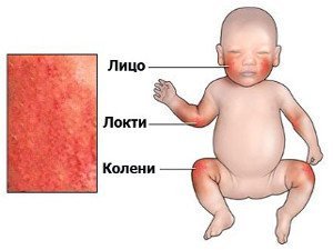 Атопический дерматит у детей лечение в израиле thumbnail