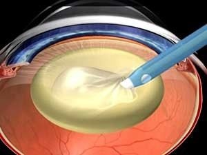 УЗ факоэмульсификация катаракты