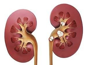 Методы лечения камней в почках в Израиле