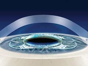 Монофокальные линзы при катаракте