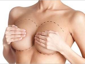Что такое пластика грудных желёз