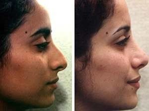 Показания для коррекции носа