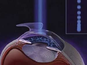 Лазерный кератомилез 