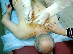 Как лечат болезнь Паркинсона в Израиле