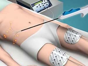 Показания для проведения абляции при раке печени