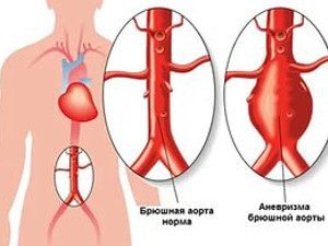 лечение аневризма в Израиле