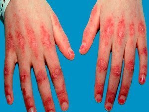 дерматомиозит у детей и лечение в Израиле