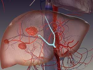 Эмболизация опухоли печени