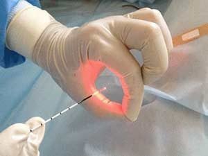 Лечение геморроя лазером