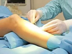 Лечение варикозного расширения вен на ногах в израиле thumbnail