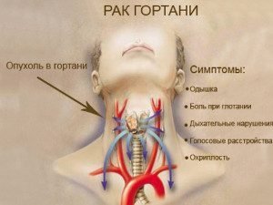 Рак гортани (опухоль горла): в каких случаях возможно полное восстановление речи и глотания?