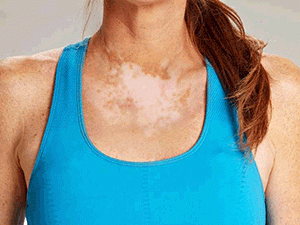 lechenie vitiligo v izraile