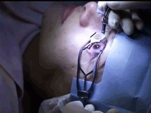 Восстановление зрения лазером в клиниках Израиля