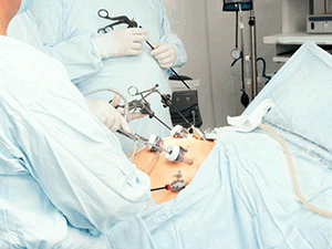 Лапароскопический метод хирургического лечения