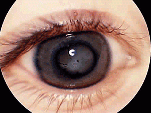 Методы лечения отслойки клетчатки в Израиле