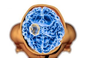 Киста головного мозга