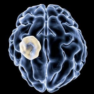 Киста головного мозга