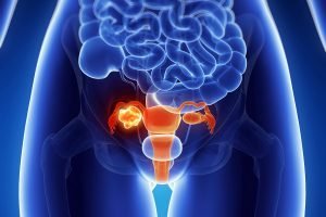 Как лечат рак шейки матки в Израиле