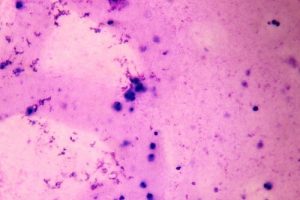 Лечение азооспермии в Израиле