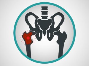 Лечение остеосаркомы в Израиле