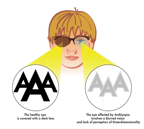 Лечение амблиопии в Израиле - ленивый глаз, инновационные методы