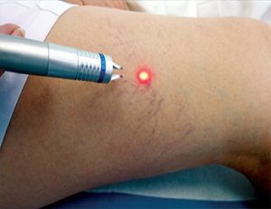 Удаление ангиомы