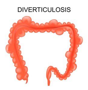 Лечение дивертикула пищевода в Израиле