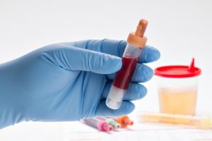 Актуальные методики лечения стенокардии в клиниках Израиля