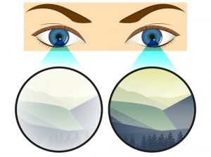 В каких случаях назначают витрэктомию глаза