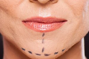 Пластика подбородка в Израиле