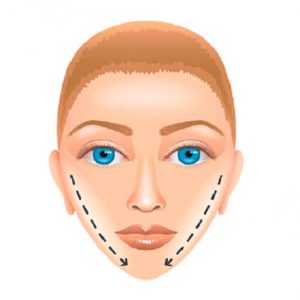 Пластика подбородка в Израиле