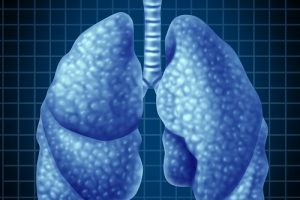 Лечение пневмофиброза в Израиле